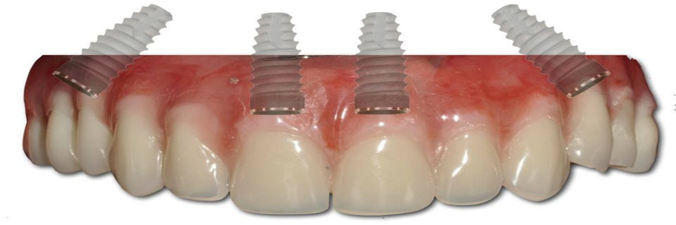 implant-dentar-total